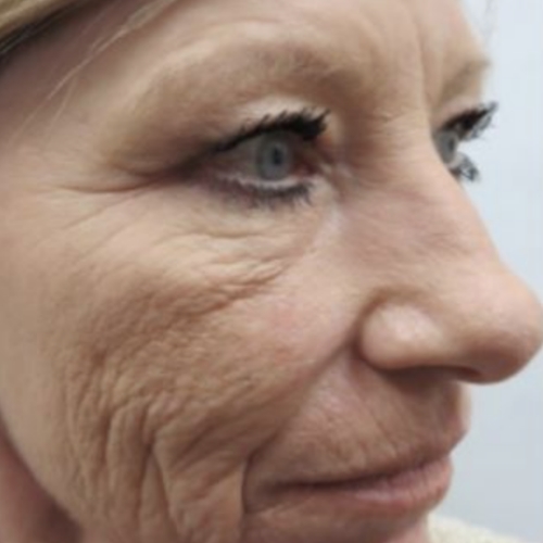 VIVACE RF Microneedling Faltenreduktion Hautstraffung Anti Aging